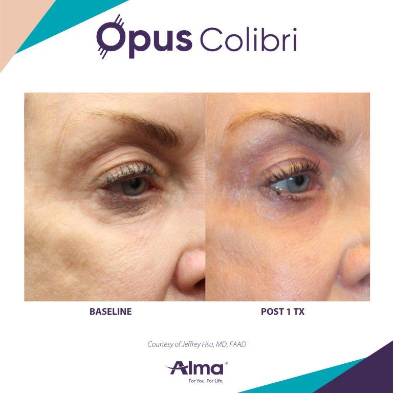 Before-and-after Opus Colibri showing tighter eyelid skin — Image 3