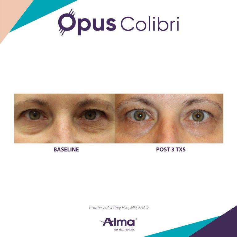 Opus Colibri before-and-after with improved fine lines near the eyes — Image 6