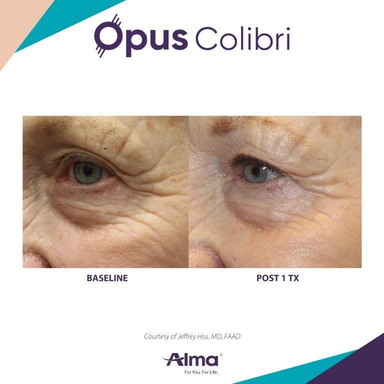 Opus Colibri eye rejuvenation results with smoother under-eye skin — Image 2