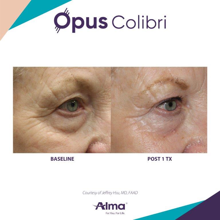 Opus Colibri before-and-after showing reduced fine lines around the eyes — Image 1