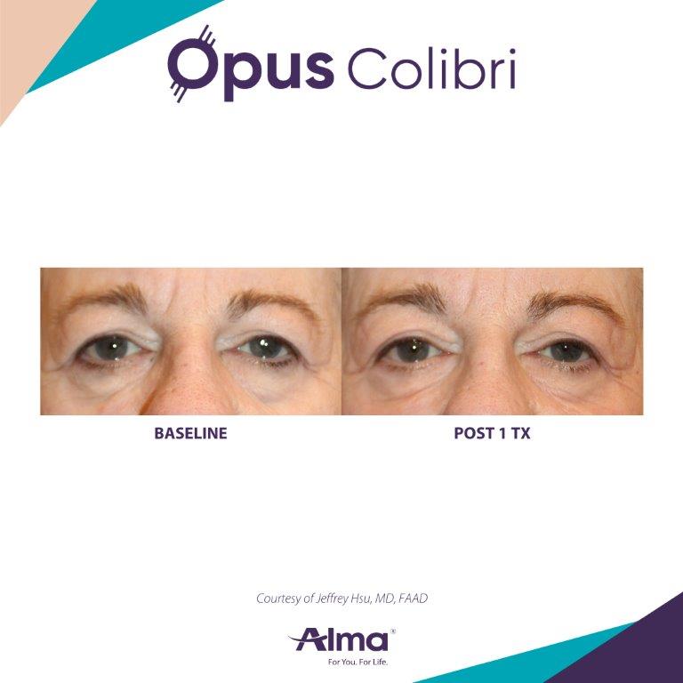 Reduction of crow’s feet after Opus Colibri eye treatment — Image 5