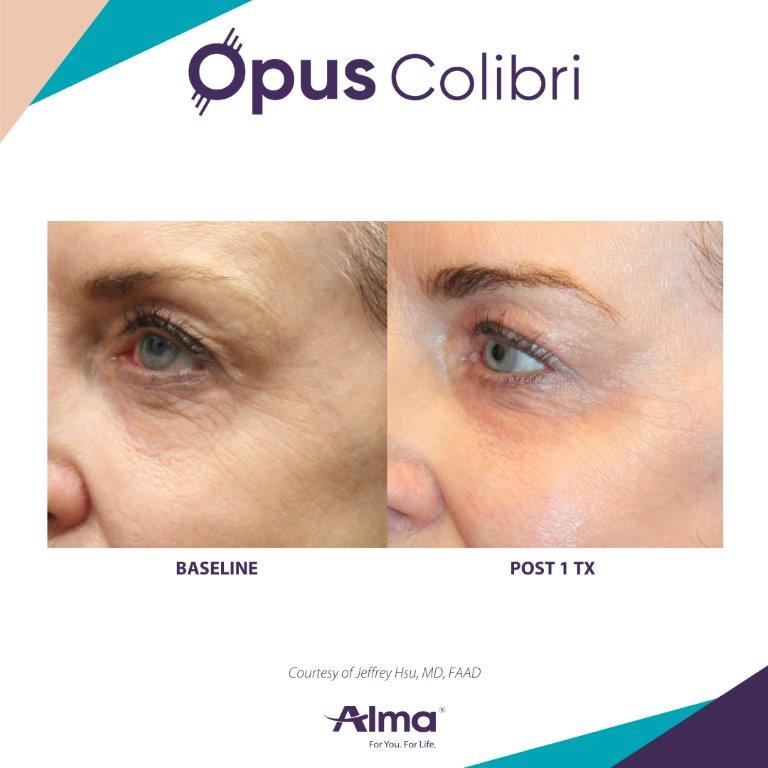 Before-and-after Opus Colibri rejuvenation with brighter under-eye tone — Image 8