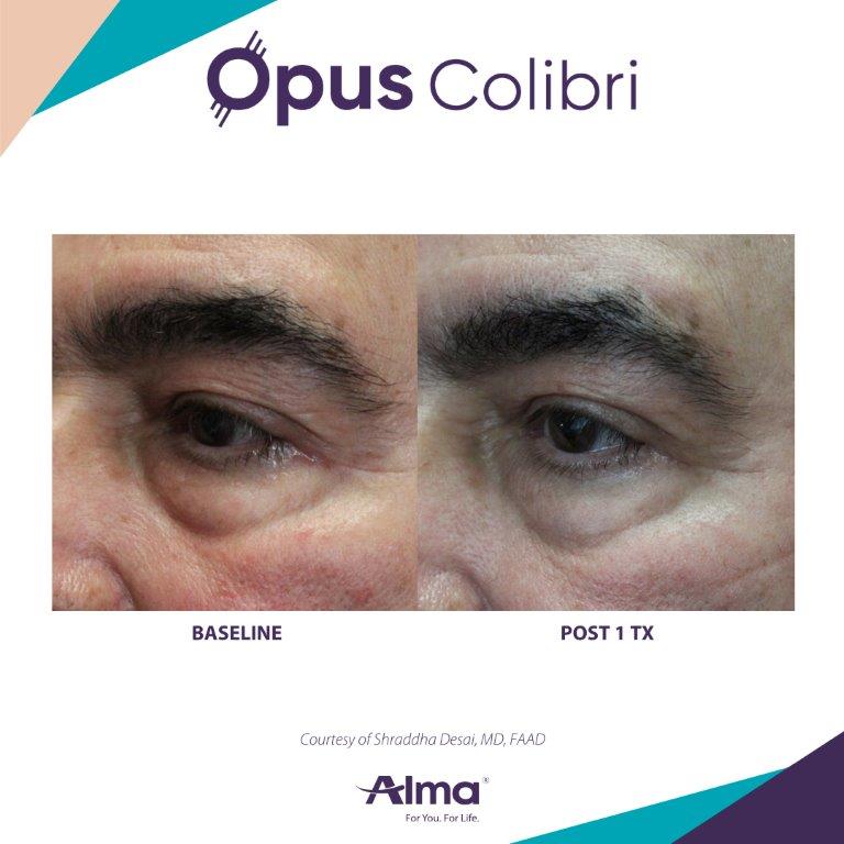 Opus Colibri eyelid rejuvenation results with improved skin smoothness — Image 4