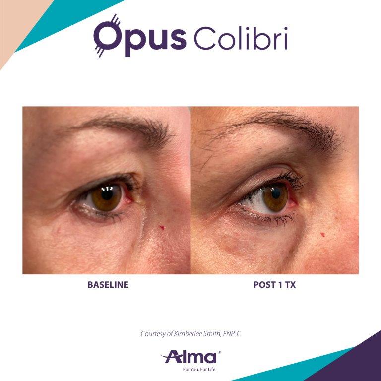 Opus Colibri results showing firmer, smoother eyelid skin — Image 7
