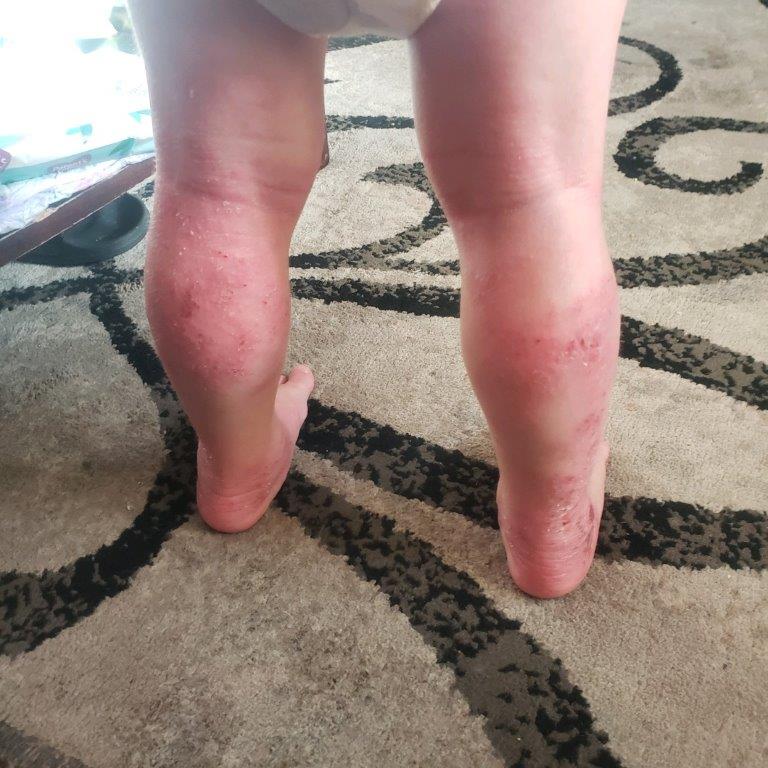 Before pediatric dermatology treatment at Associated Dermatology & Skin Cancer Clinic in Helena, Montana, showing a visible rash on a child’s legs prior to care.