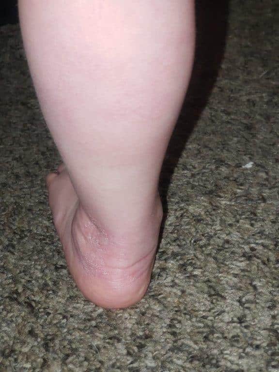 After pediatric dermatology treatment at Associated Dermatology & Skin Cancer Clinic in Helena, Montana, showing clear and healthy skin following care.