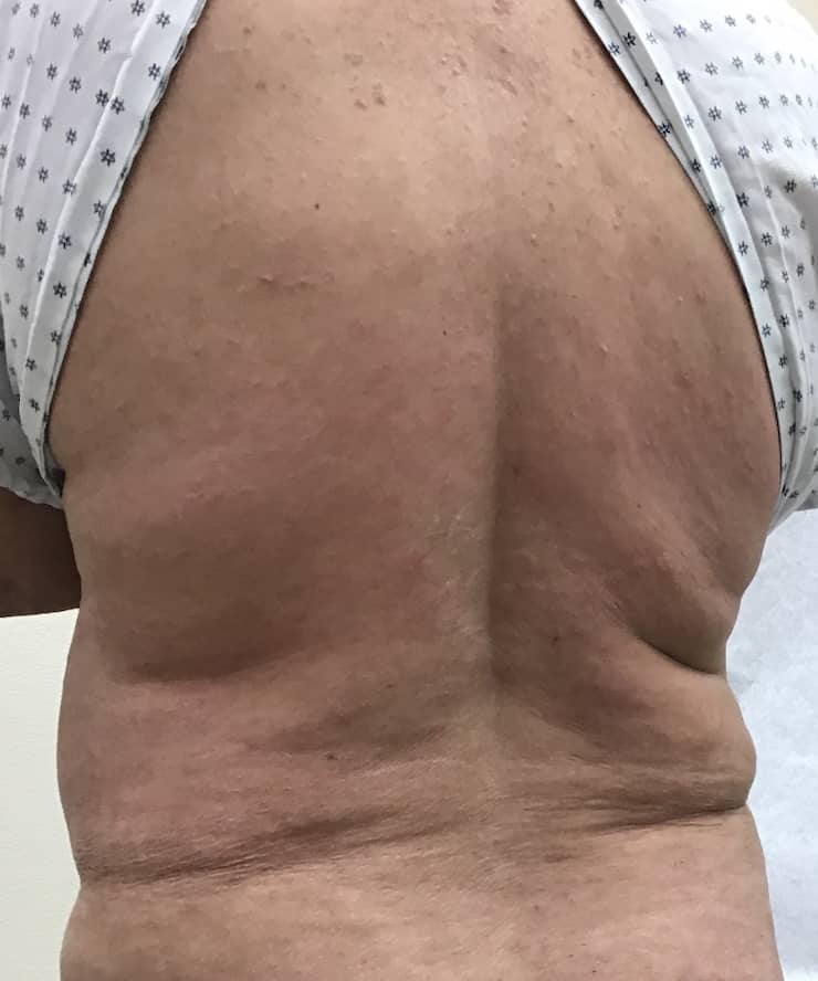 After dermatology treatment at Associated Dermatology in Helena, Montana showing improvement in the skin condition.