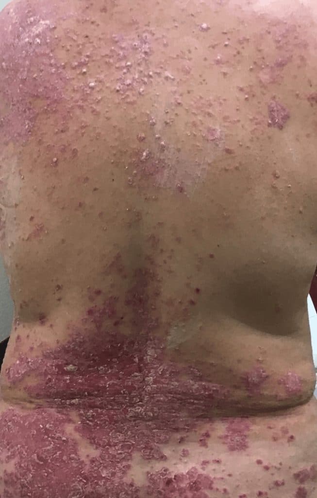 Before dermatology treatment at Associated Dermatology in Helena, Montana showing a visible skin condition.