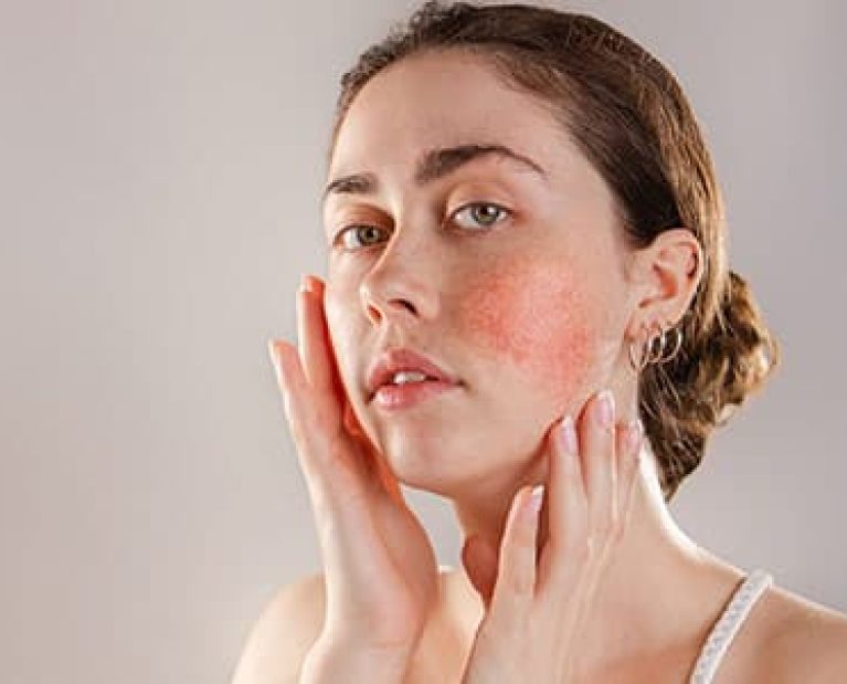 Close-up of a woman’s face with a red skin rash – dermatology treatment example